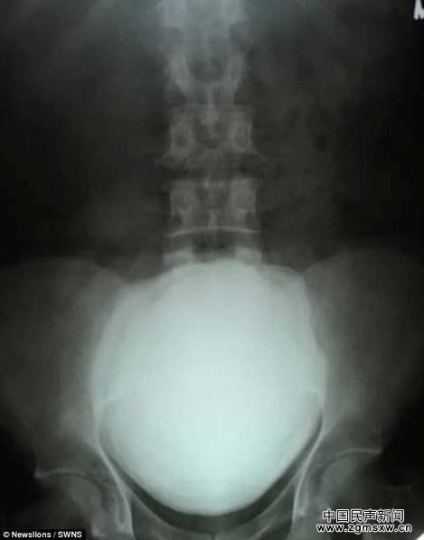 印度男子腹痛入院 膀胱取出1.5公斤巨型结石(图)