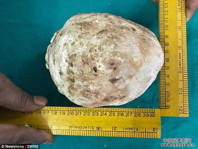印度男子腹痛入院 膀胱取出1.5公斤巨型结石(图)